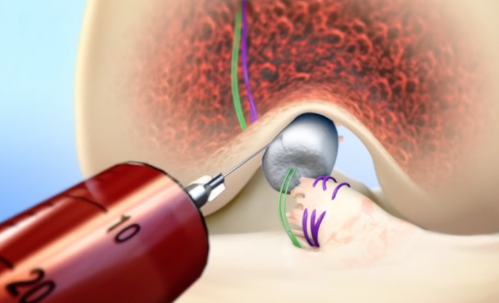 Bridge-Enhanced ACL Repair (BEAR) | Boston Children's Hospital